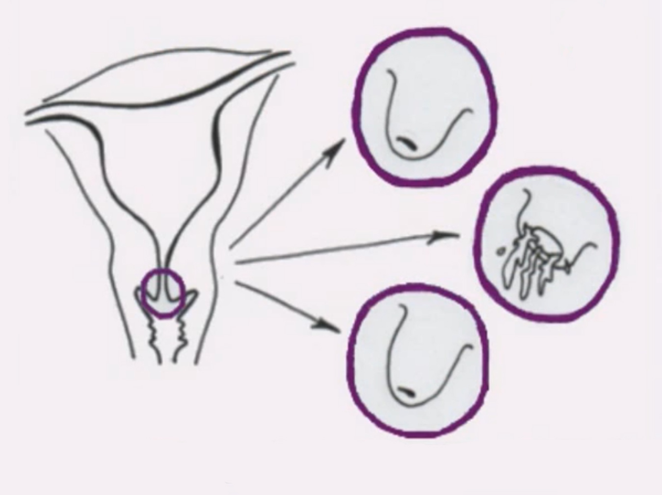 Schwangerschaft ertasten gebärmutter Muttermund fingerdurchlässig: